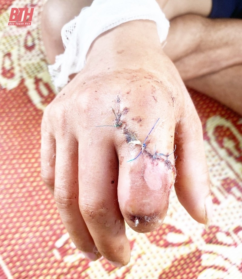 Nối thành công ngón tay bị đứt lìa cho bệnh nhân bằng kỹ thuật vi phẫu