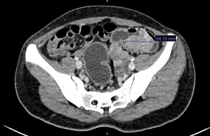 Hình ảnh CT (chụp cắt lớp) cho thấy có khối u gần 5 cm ở đại tràng. Ảnh: Bệnh viện cung cấp