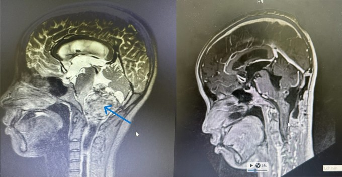 Hình ảnh chụp khối u ở vị trí thân não (bên trái) và sau khi khối u được phẫu thuật loại bỏ (bên phải). Ảnh: Bệnh viện cung cấp