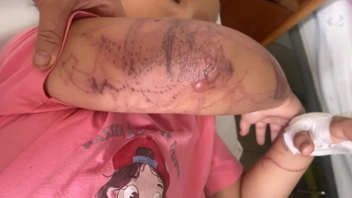 Bị sứa đốt khi tắm biển, bé 7 tuổi nhập viện trong tình trạng mất ý thức - 1