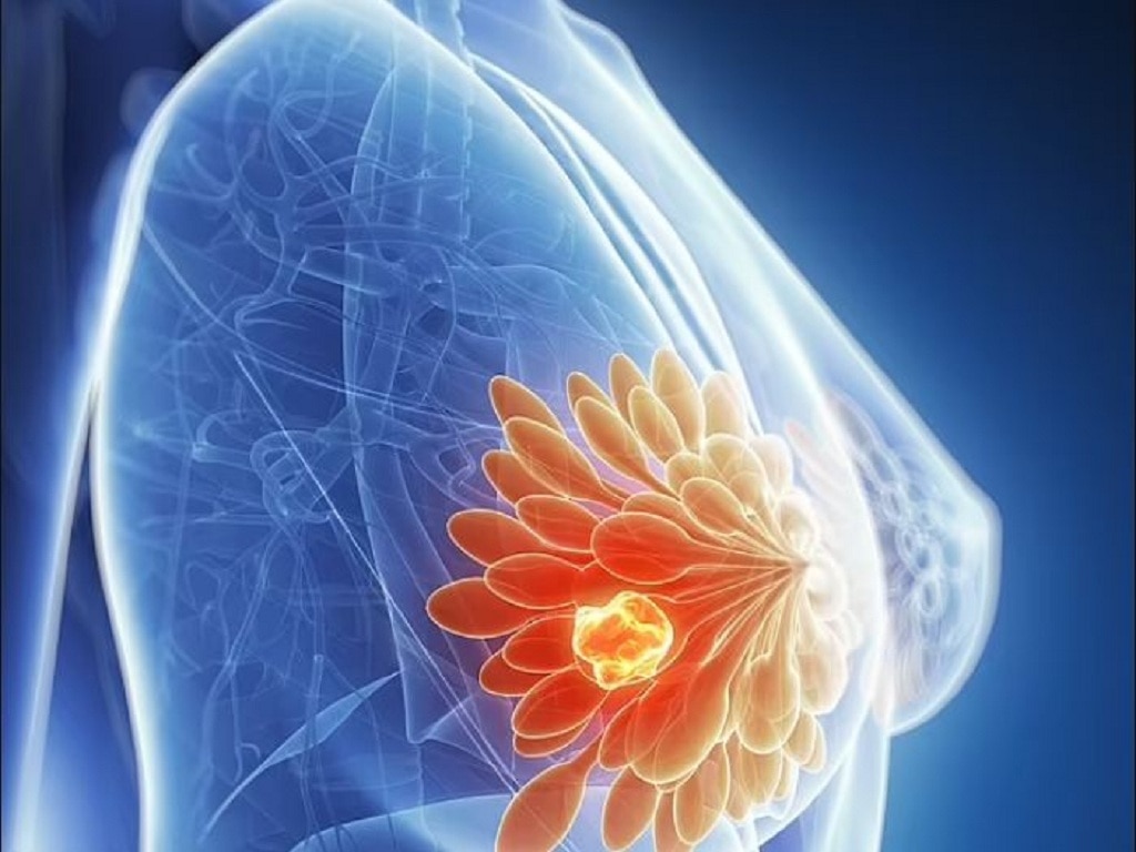 Loại thuốc có sẵn giảm đến 25 % nguy cơ tái phát ung thư vú - Ảnh 1.