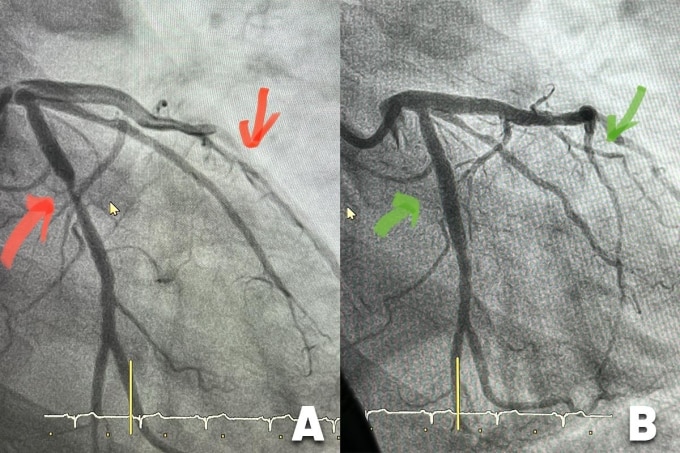 Hình ảnh cho thấy hai nhánh mạch vành hẹp tới 90% (hình A) và sau khi được tái thông (hình B). Ảnh: Bệnh viện Tâm Anh