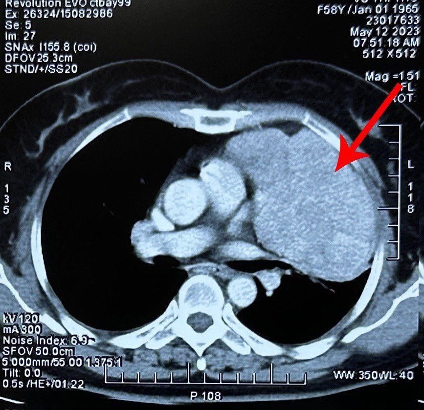 Nữ bệnh nhân phát hiện u phổi ác tính khi đi mổ ruột thừa - Ảnh 1.