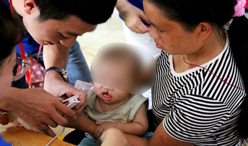 Bác sĩ khám cho trẻ bị dị tật vùng mặt trước khi phẫu thuật tại Bệnh viện Trung ương Thái Nguyên.