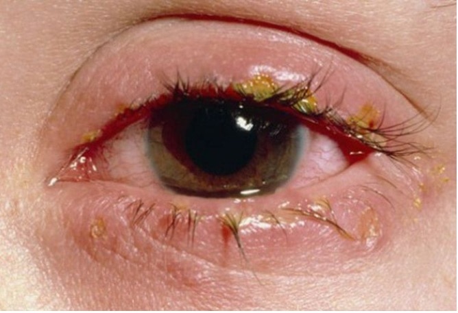 TP.HCM: Nhiều người bị đau mắt đỏ, nhức mắt, đổ ghèn - Ảnh 1.