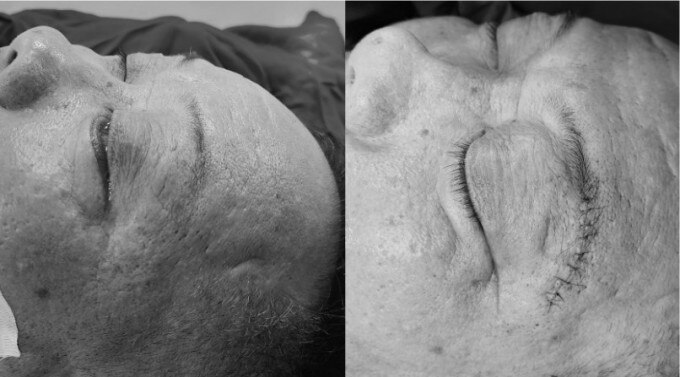 Ảnh trước mổ mắt nhắm không kín(trái) và ảnh sau mổ mắt nhắm kín (phải). Ảnh bệnh viện cung cấp