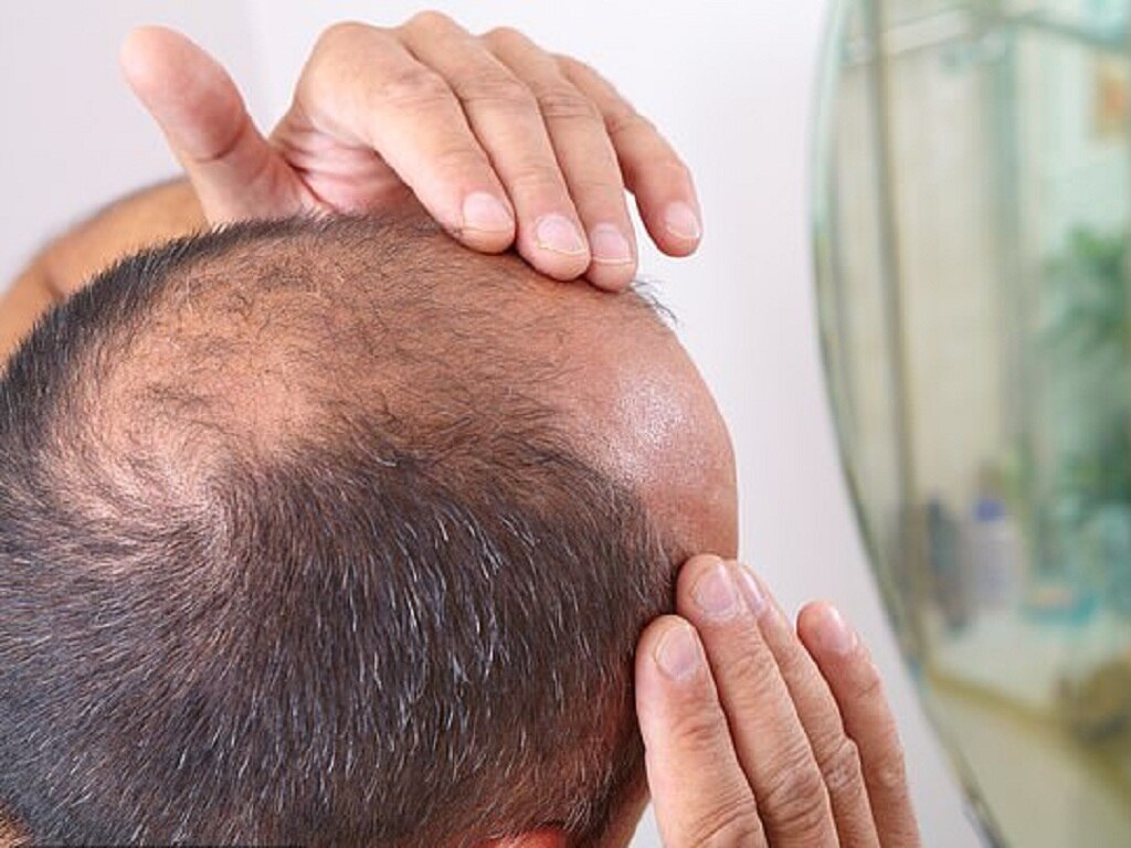 Alopecia areata: 3 products for bald patches on your head - Hair Growth  Specialist | The Hair Growth Specialist