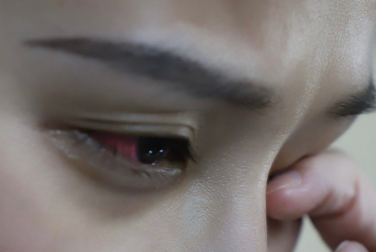 Biến thể vi-rút coxsackie A24 gây đau mắt đỏ nguy hiểm như thế nào - Ảnh 1.