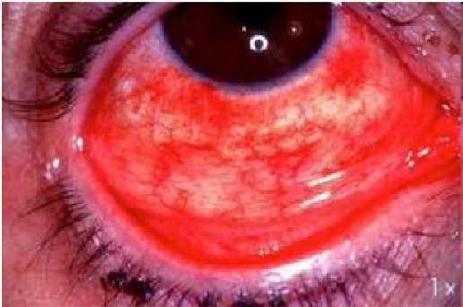 Vệ sinh mắt đúng cách để phòng ngừa đau mắt đỏ như thế nào? - Ảnh 1.
