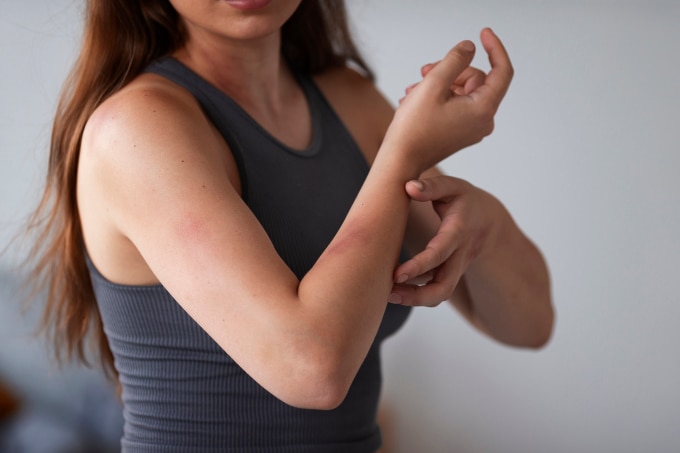 Khi bị muỗi đốt, nên tránh gãi nhiều gây rách da, vết thương lâu lành hơn và nguy cơ để lại sẹo. Ảnh: Freepik