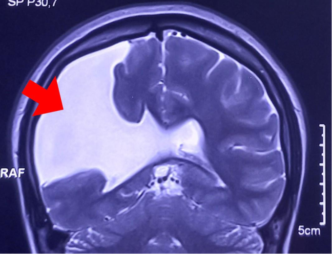 Chụp MRI sọ não cho thấy khe nứt não lớn bị dịch não tủy tràn vào (phần màu trắng). Ảnh: Bệnh viện cung cấp