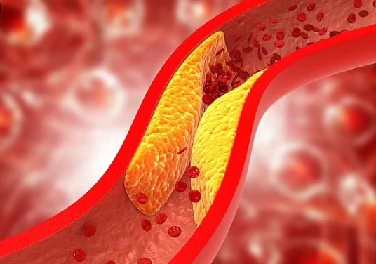 5 điều quan trọng để người trên 50 tuổi kiểm soát cholesterol, tránh đau tim- Ảnh 1.