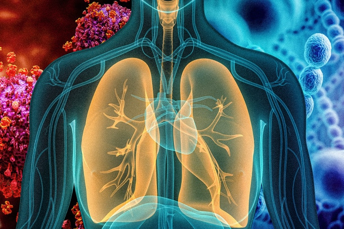 Hình minh họa bệnh nhân viêm phổi. Ảnh: MIT
