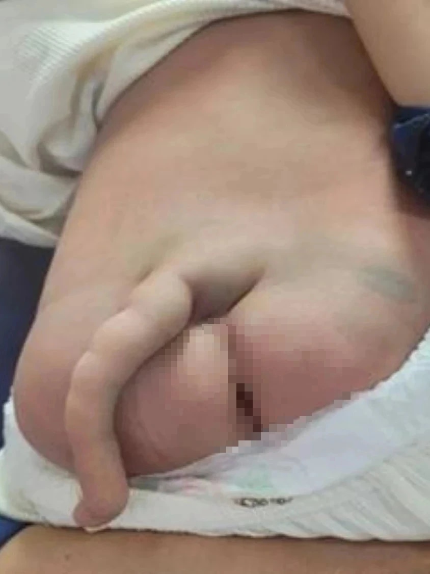 Phẫu thuật cắt 'đuôi' dài 14 cm cho bé trai 4 tháng tuổi - Ảnh 1.