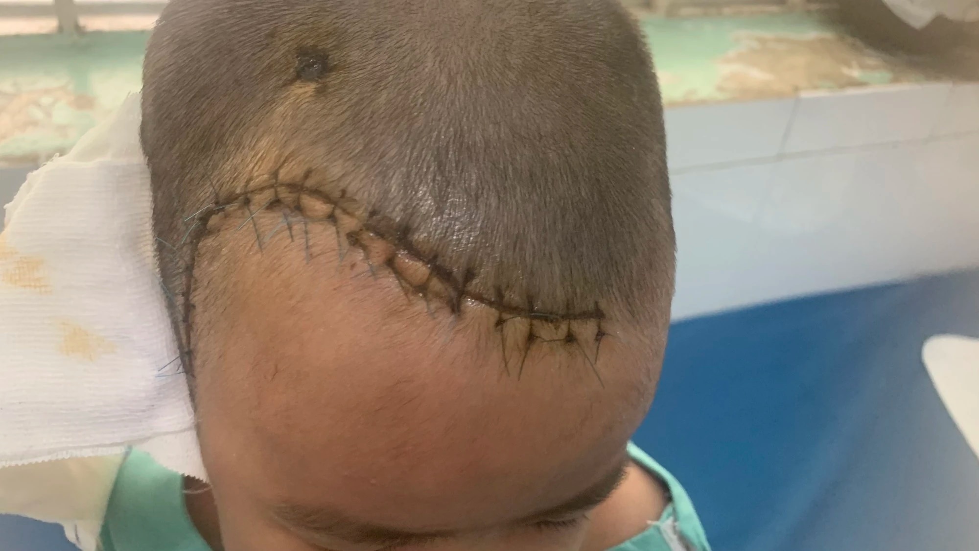 Té cầu thang, bé trai 4 tuổi bị tổn thương não nặng - Ảnh 1.