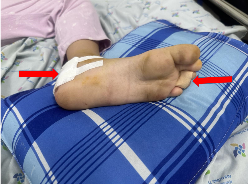 Chân cuốn vào căm xe máy, bé gái bị lóc da, đứt gân- Ảnh 1. Chân cuốn vào căm xe máy, bé gái bị lóc da, đứt gân- Ảnh 1.