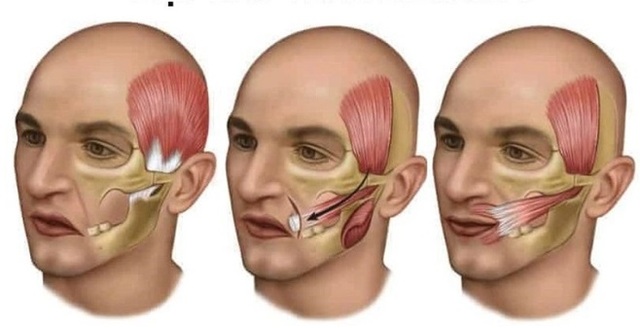 Thanh niên 20 tuổi đang khỏe mạnh bỗng méo miệng vì mắc sai lầm này trong lúc gội đầu - Ảnh 3. Thanh niên 20 tuổi đang khỏe mạnh bỗng méo miệng vì mắc sai lầm này trong lúc gội đầu - Ảnh 3.