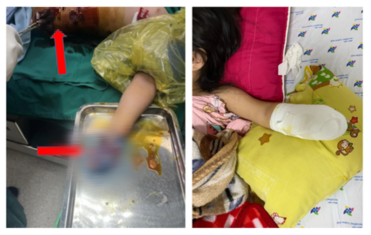 Lượm pháo chơi, bé gái mất một bàn tay- Ảnh 1. Lượm pháo chơi, bé gái mất một bàn tay- Ảnh 1.