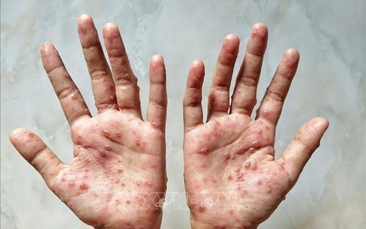 Người đàn ông ở Cà Mau mắc đậu mùa khỉ- Ảnh 1. Bóng nước nổi trên da tay bệnh nhân đậu mùa khỉ - Ảnh minh họa
