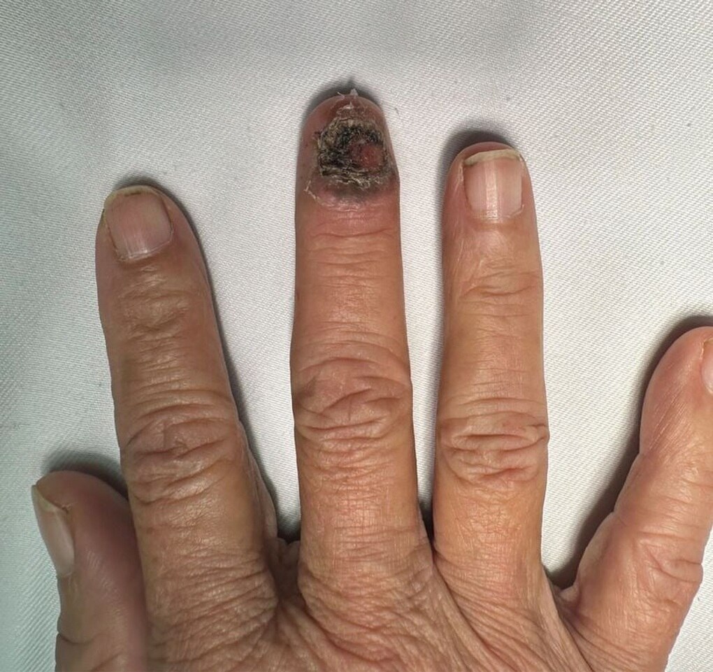 Chemo nails | Mom (with cancer, twice) blog: It's Because I Said So!