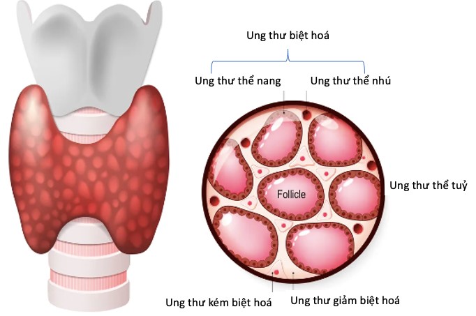 Các dấu hiệu sớm của ung thư tuyến giáp cần biết- Ảnh 2. Các dấu hiệu sớm của ung thư tuyến giáp cần biết- Ảnh 2.
