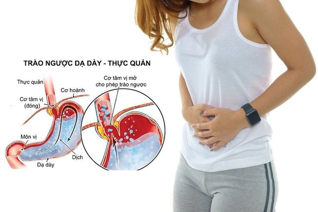 Dấu hiệu ho do bị trào ngược dạ dày, rất nhiều người không biết - Ảnh 3. Dấu hiệu ho do bị trào ngược dạ dày, rất nhiều người không biết - Ảnh 3.
