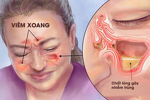 Thời tiết thay đổi, người bị viêm xoang cần làm gì để ngừa tái phát - Ảnh 3. Thời tiết thay đổi, người bị viêm xoang cần làm gì để ngừa tái phát - Ảnh 3.