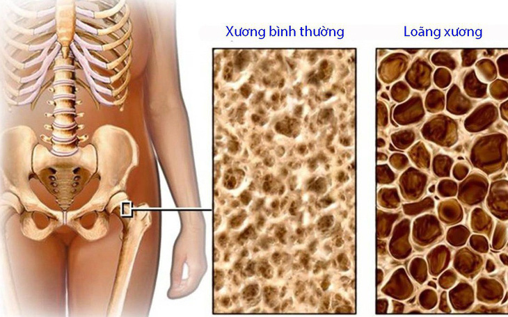 Cảnh báo suy tuyến thượng thận, mặt to tròn vì lạm dụng thuốc kháng viêm- Ảnh 2. Tai biến do lạm dụng corticoid