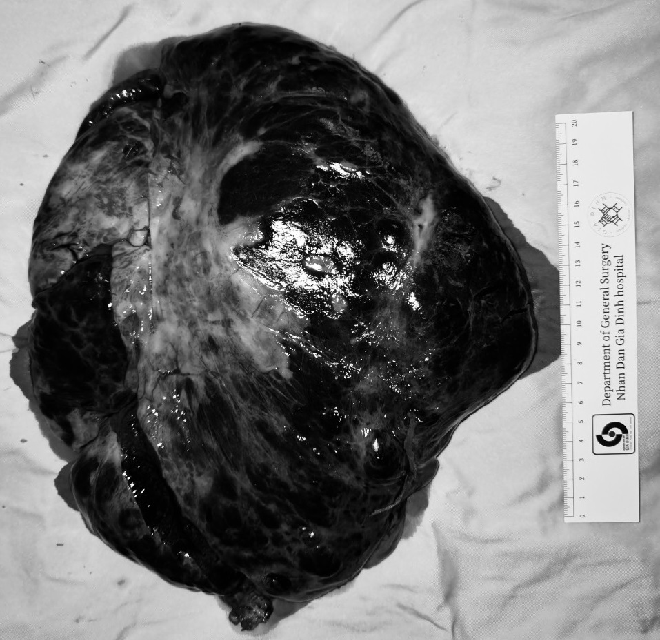 Cắt bỏ thành công khối u máu gan nặng hơn 5 kg- Ảnh 1. Cắt bỏ thành công khối u máu gan nặng hơn 5 kg- Ảnh 1.