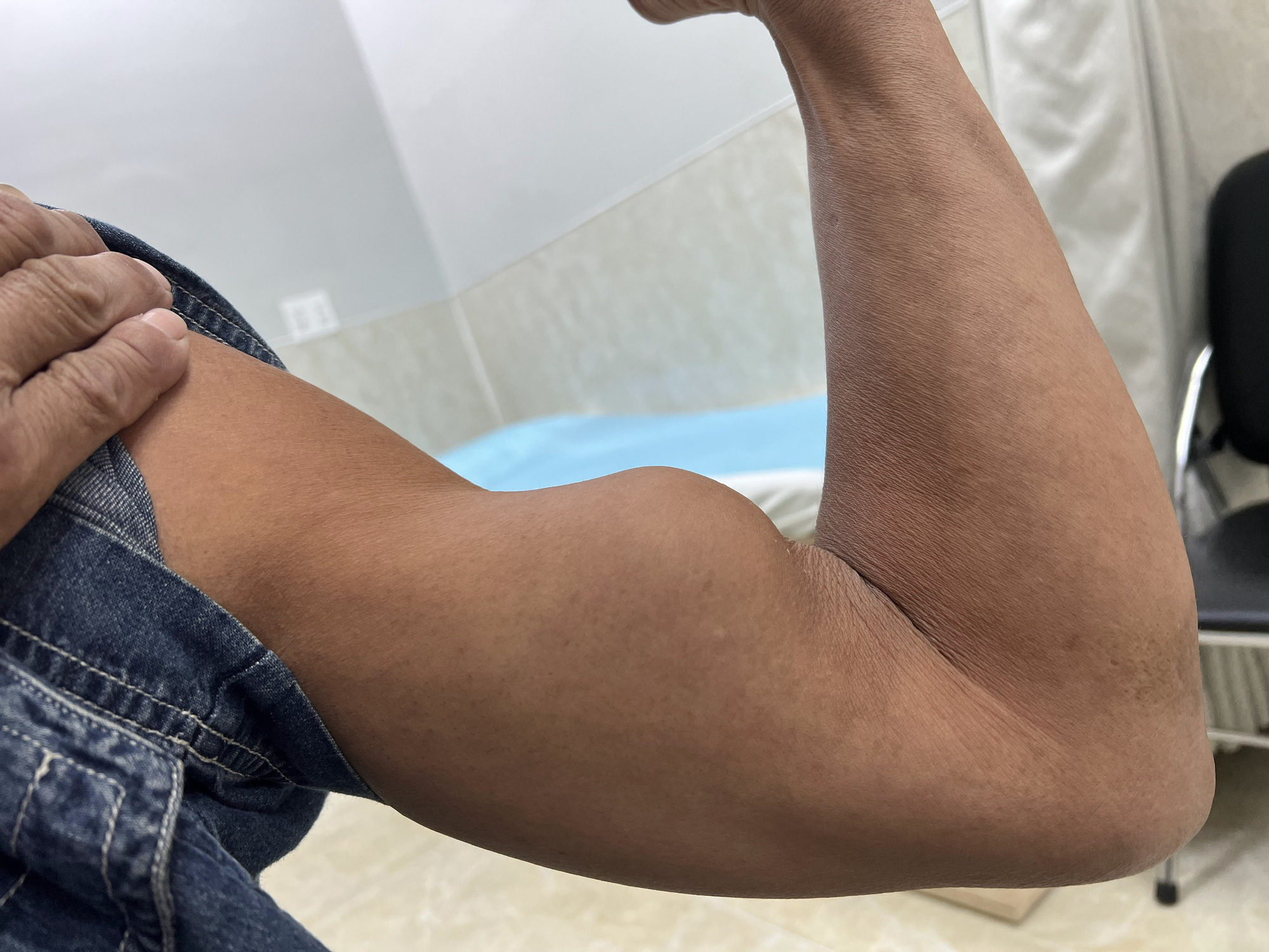 Bệnh nhân bị đứt gân con chuột ở cánh tay - Ảnh: BS NGUYỄN TIẾN LỘC Bệnh nhân bị đứt gân con chuột ở cánh tay - Ảnh: BS NGUYỄN TIẾN LỘC