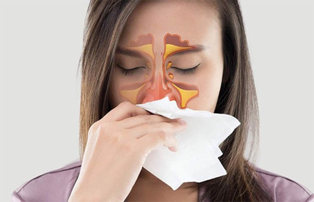 Thời tiết thay đổi, người bị viêm xoang cần làm gì để ngừa tái phát - Ảnh 2. Thời tiết thay đổi, người bị viêm xoang cần làm gì để ngừa tái phát - Ảnh 2.