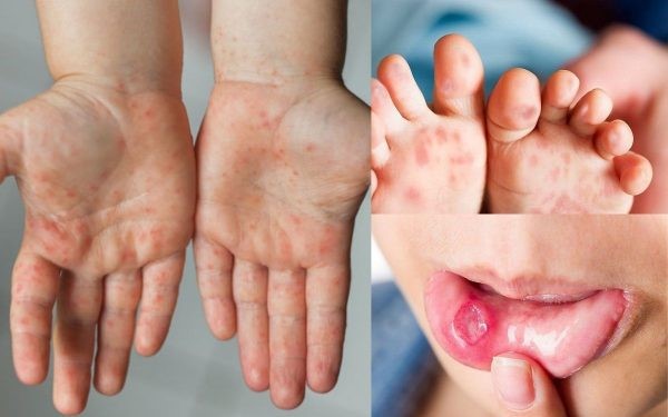 Cẩn trọng với những biến chứng tay chân miệng ở trẻ em!- Ảnh 2. Cẩn trọng với những biến chứng tay chân miệng ở trẻ em!- Ảnh 2.