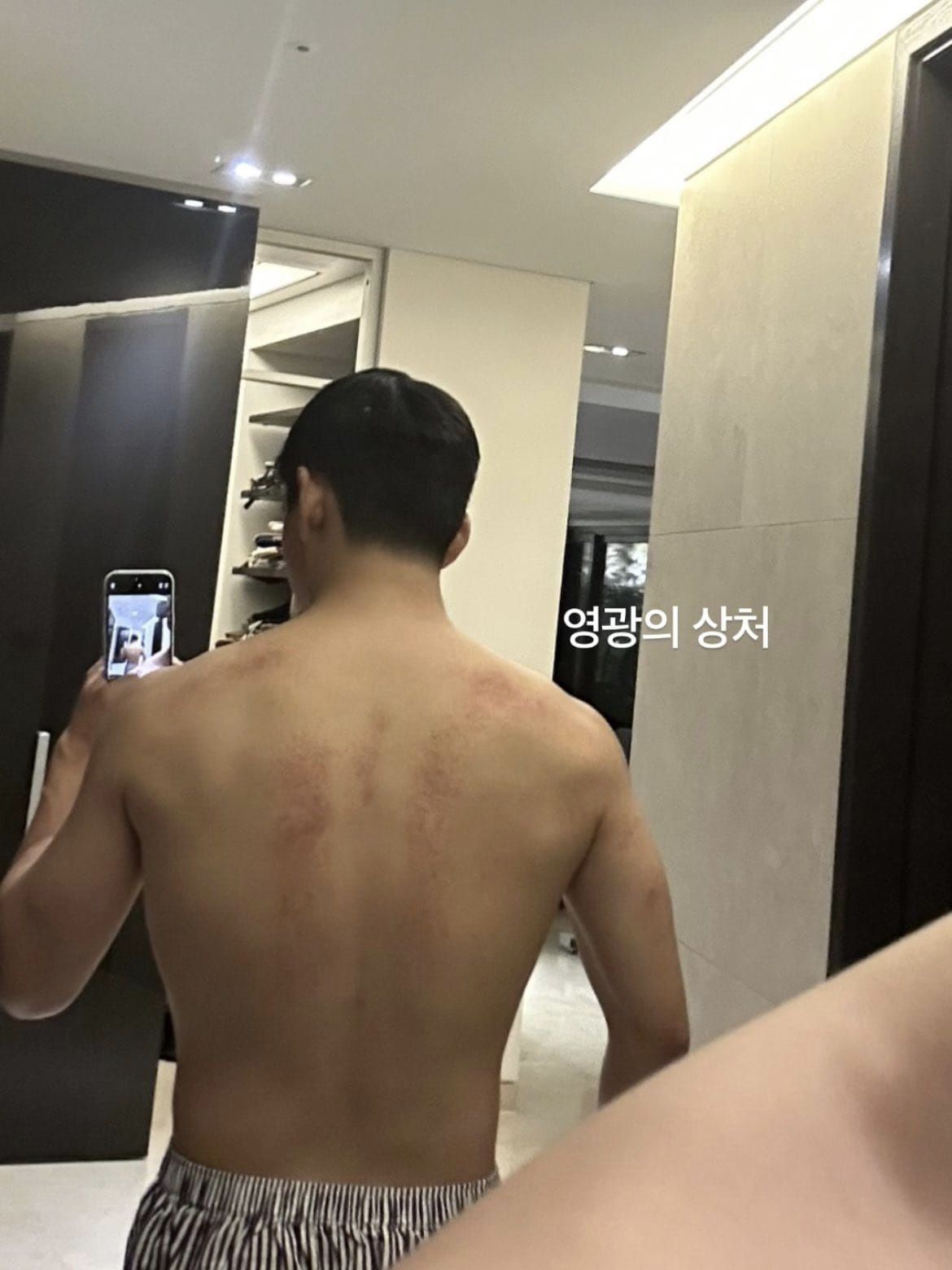 V để lộ những vết thương trên lưng. Ảnh: Instagram