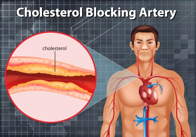 Mức cholesterol cao có thể dẫn đến nguy cơ bị huyết áp cao, bệnh tim và đột quỵ