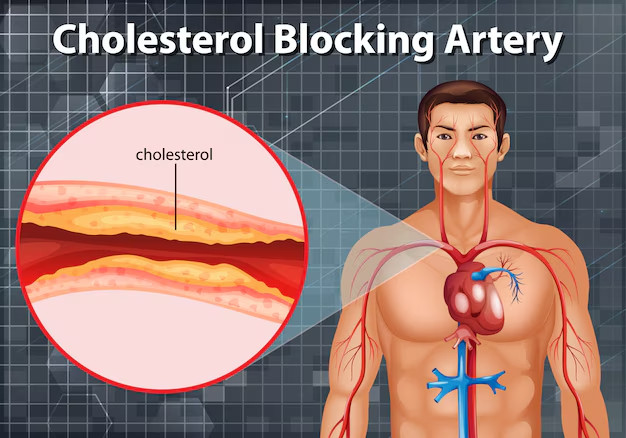 Mức cholesterol cao có thể dẫn đến nguy cơ bị huyết áp cao, bệnh tim và đột quỵ