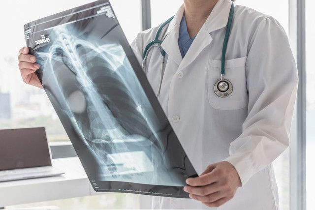 Đau xương khớp kéo dài, cảnh giác với ung thư phổi di căn- Ảnh 2. Đau xương khớp kéo dài, cảnh giác với ung thư phổi di căn- Ảnh 2.