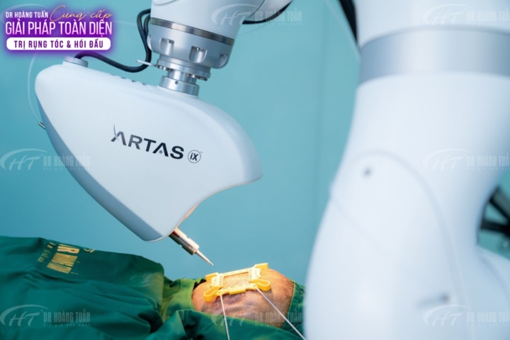 ARTAS® IXi là nền tảng cấy ghép tóc thông minh đầu tiên trên thế giới sử dụng công nghệ trí tuệ nhân tạo AI, hệ thống camera phân giải cao và robot tiên tiến.