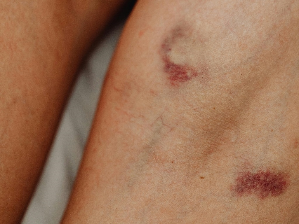 Лейкемия снижает количество тромбоцитов в крови и приводит к легкому образованию синяков на коже.