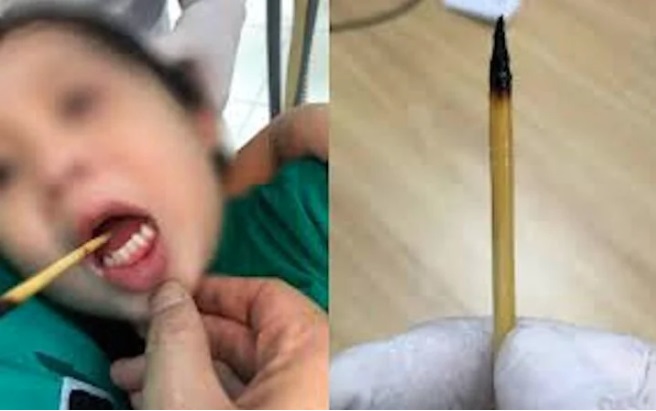 Bé 3 tuổi bị que xiên thịt đâm xuyên lưỡi - Ảnh 1. Bé 3 tuổi bị que xiên thịt đâm xuyên lưỡi - Ảnh 1.