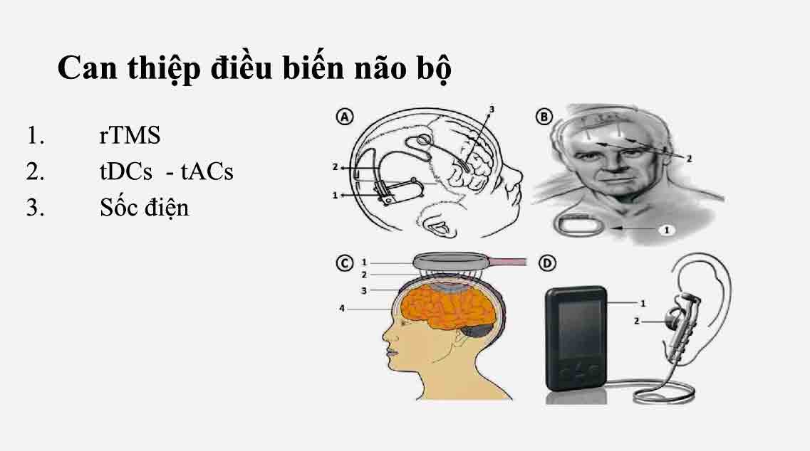 Can thiệp điều biến não bộ được chỉ định với một số ca bệnh rối loạn ám ảnh