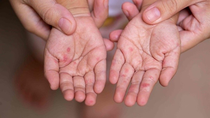 Cẩn trọng với những biến chứng tay chân miệng ở trẻ em!- Ảnh 1. Cẩn trọng với những biến chứng tay chân miệng ở trẻ em!- Ảnh 1.