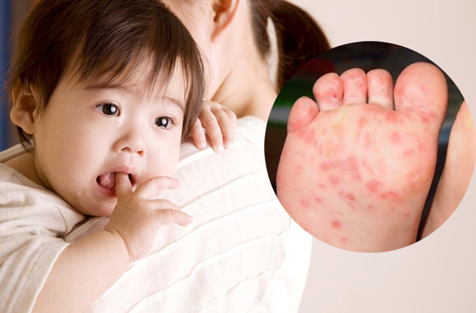 Cẩn trọng với những biến chứng tay chân miệng ở trẻ em!- Ảnh 3. Cẩn trọng với những biến chứng tay chân miệng ở trẻ em!- Ảnh 3.