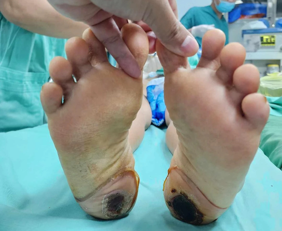 Chữa đau cột sống bằng 'kinh nghiệm dân gian', bệnh nhân suýt liệt vĩnh viễn- Ảnh 1. Nữ bệnh nhân suýt bị liệt vĩnh viễn do chữa bệnh bằng phương pháp dân gian