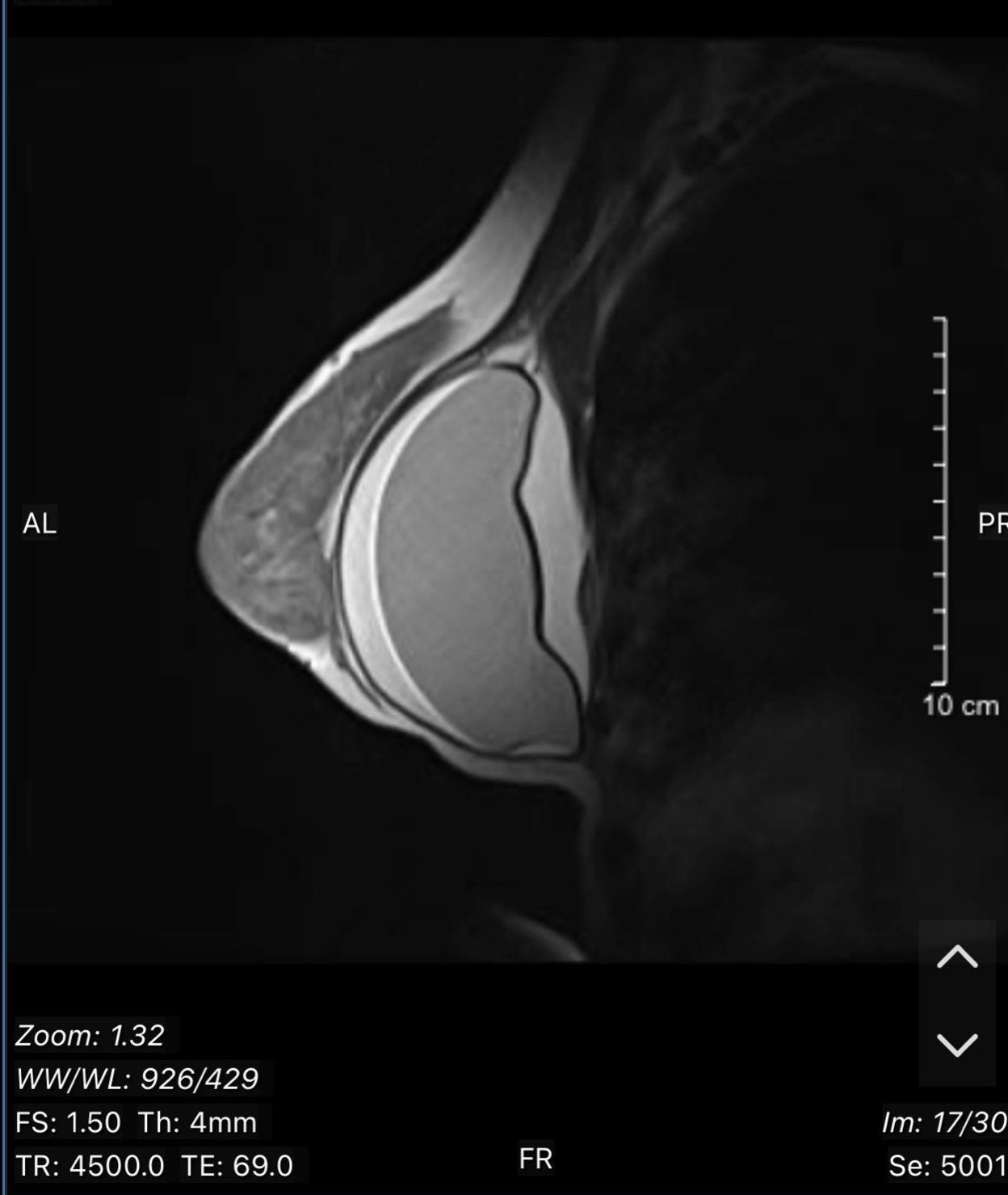 Hình ảnh MRI ngực trái của bệnh nhân vỡ túi ngực - Ảnh: Bác sĩ cung cấp Hình ảnh MRI ngực trái của bệnh nhân vỡ túi ngực - Ảnh: Bác sĩ cung cấp