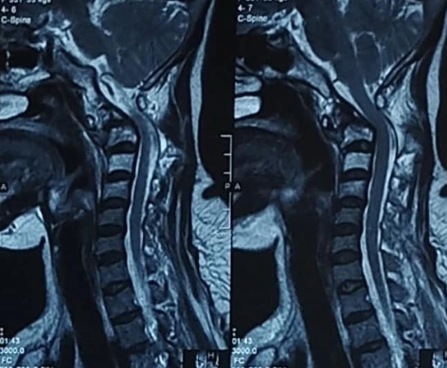 Đau xương khớp kéo dài, cảnh giác với ung thư phổi di căn- Ảnh 1. Đau xương khớp kéo dài, cảnh giác với ung thư phổi di căn- Ảnh 1.