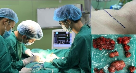 Thanh niên 24 tuổi phát hiện ung thư tuyến giáp, phải cắt toàn bộ tuyến giáp vì mắc 1 sai lầm mà nhiều người Việt mắc phải- Ảnh 2.