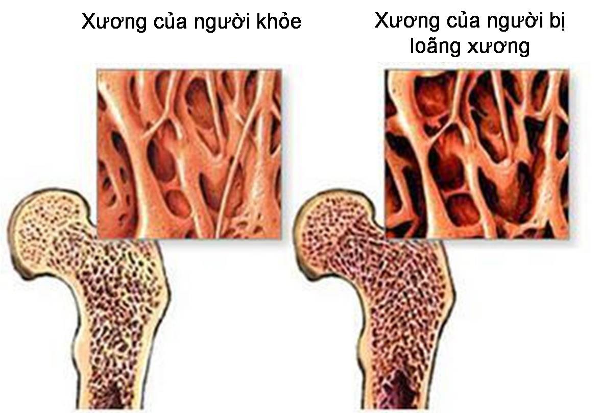 Xoa bóp bấm huyệt có lợi ích gì với người loãng xương?- Ảnh 1. Xoa bóp bấm huyệt có lợi ích gì với người loãng xương?- Ảnh 1.