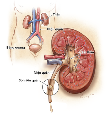 Người phụ nữ 53 tuổi ở Phú Thọ phải cắt 1 bên thận vì chủ quan với chứng bệnh này - Ảnh 3. Người phụ nữ 53 tuổi ở Phú Thọ phải cắt 1 bên thận vì chủ quan với chứng bệnh này - Ảnh 3.
