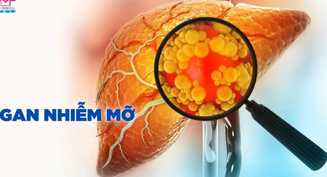 4 cấp độ của bệnh gan nhiễm mỡ, ai không có xin chúc mừng- Ảnh 2. 4 cấp độ của bệnh gan nhiễm mỡ, ai không có xin chúc mừng- Ảnh 2.