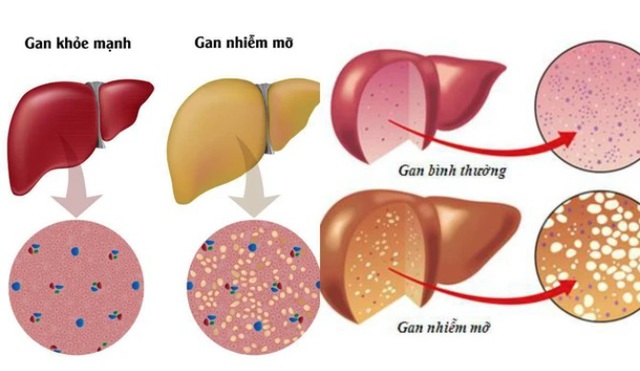 4 cấp độ của bệnh gan nhiễm mỡ, ai không có xin chúc mừng- Ảnh 3. 4 cấp độ của bệnh gan nhiễm mỡ, ai không có xin chúc mừng- Ảnh 3.